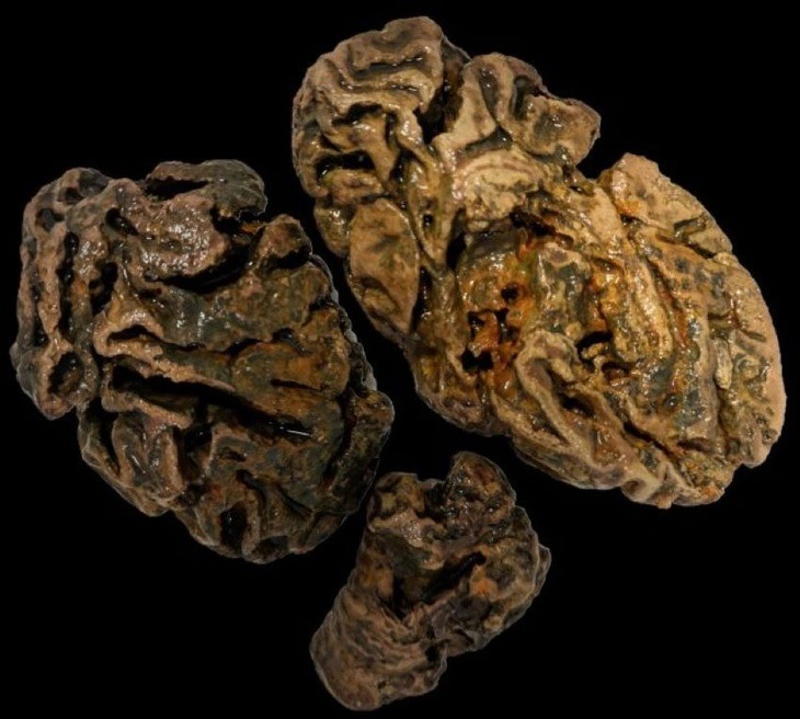 Những phần não của một người được chôn trong nghĩa trang ở Vương quốc Anh cách đây khoảng 200 năm